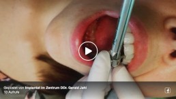 Video Implantat im Zentrum