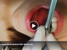 Video Implantat im Zentrum