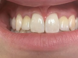 All-on-4 - Schöne Zähne