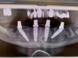 4 Implantate